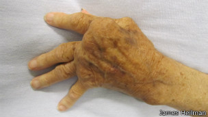 Pessoas com artrite reumatoide desenvolvem inflamações nas articulações.